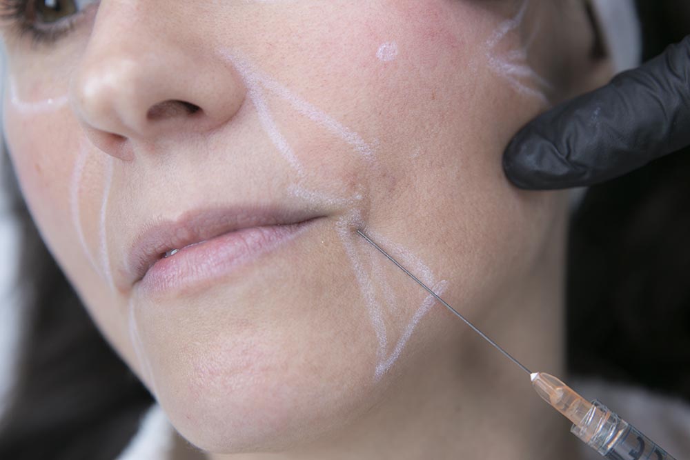 injection acide hyaluronique levres bordeaux