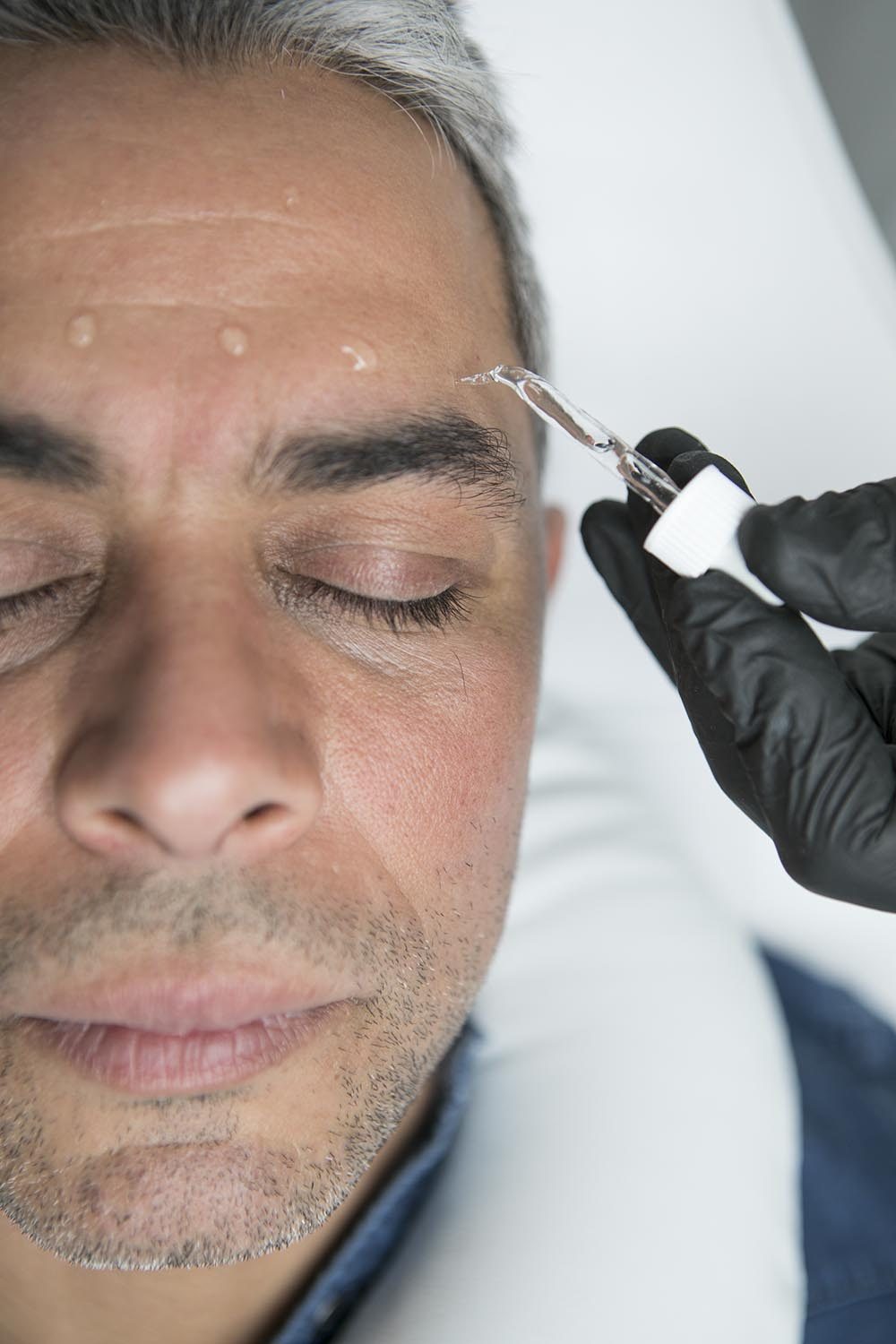 Microneedling : soin hydrafacial, mésothérapie esthétique visage en Nouvelle-Aquitaine 