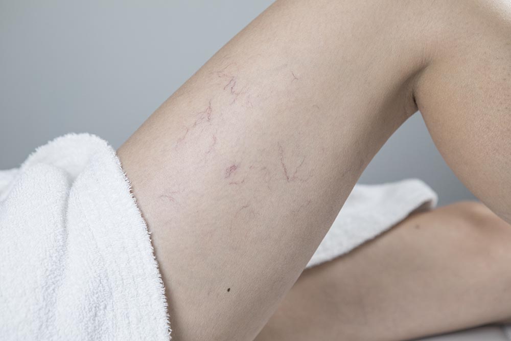 Traitements vasculaires au laser, traitement rosacée, cabinet de médecine esthétique à Bordeaux